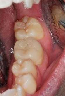 Cracked-Tooth-Repair-After-Image