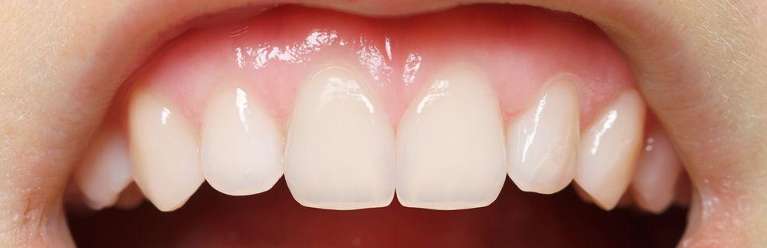 Dental-Bonding-After-Image