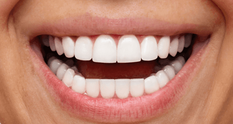 Porcelain-Veneers-After-Image