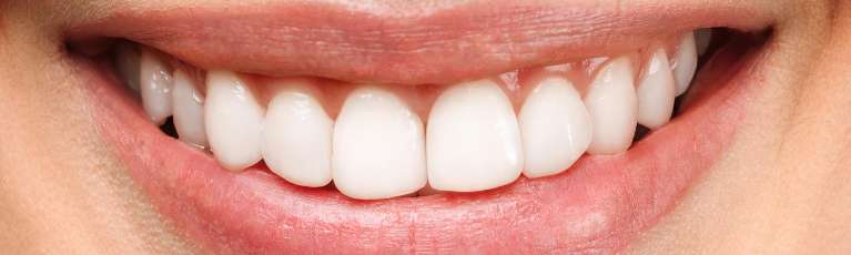 Teeth-Whitening-After-Image
