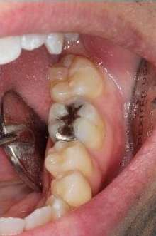 Cracked-Tooth-Repair-Before-Image
