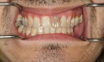 Crowns-Bridges-Before-Image