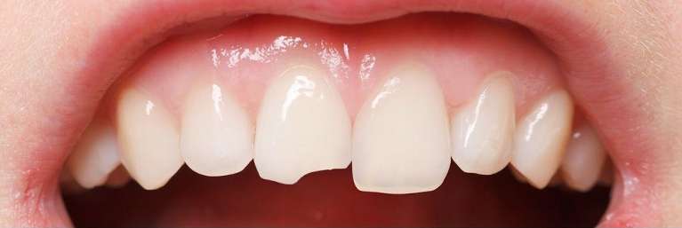 Dental-Bonding-Before-Image