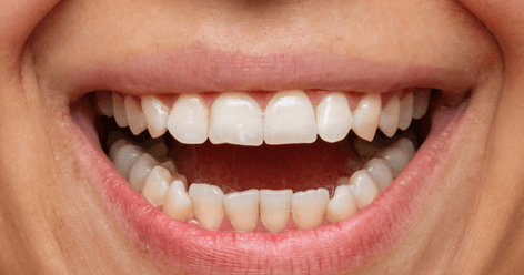 Porcelain-Veneers-Before-Image