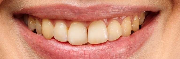 Teeth-Whitening-Before-Image